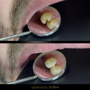 Obturatie premolari compozit Dentics Team